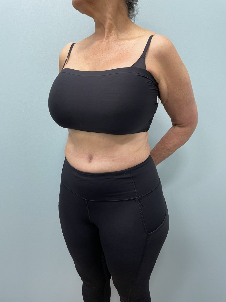 Tummy Tuck Patient Photo - Case 3686 - after view