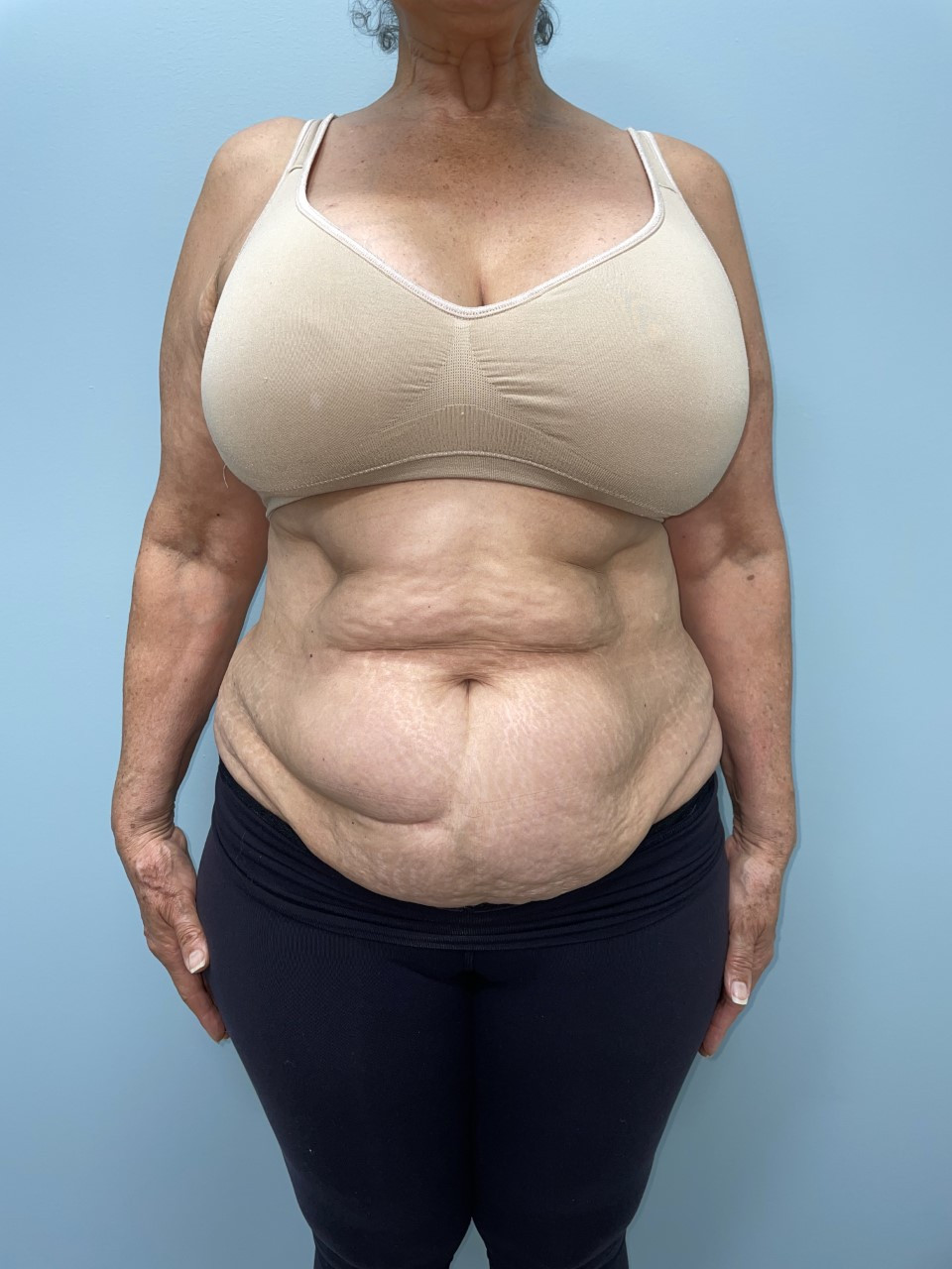 Tummy Tuck Patient Photo - Case 3686 - before view-4