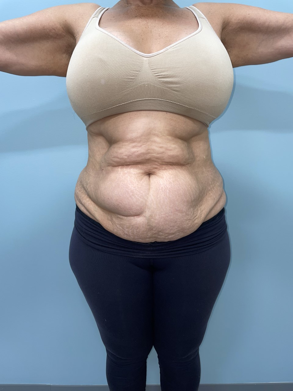 Tummy Tuck Patient Photo - Case 3686 - before view-0