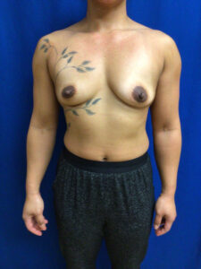 Breast Augmentation - Case 3723 - Before