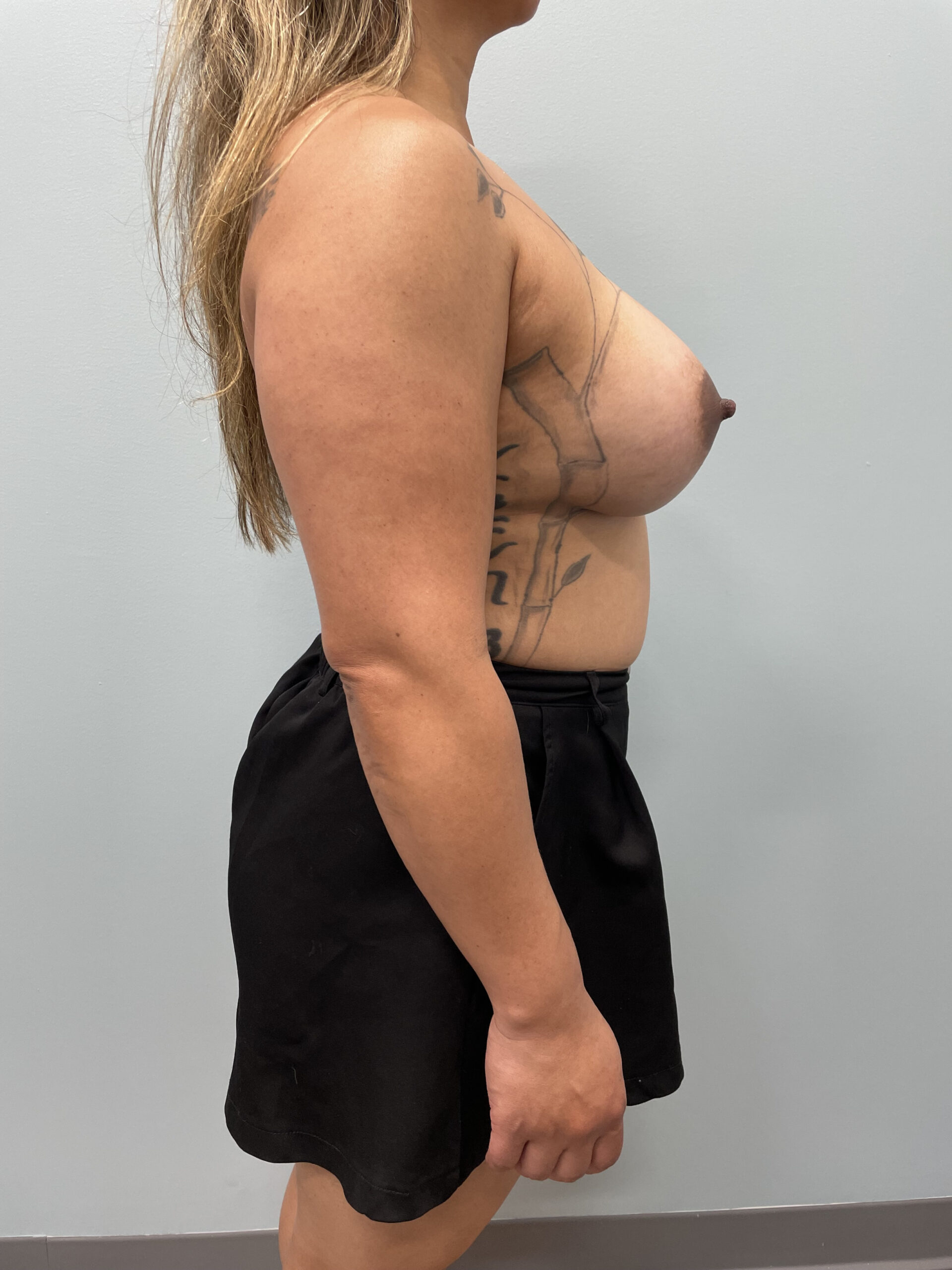 Breast Augmentation Patient Photo - Case 3723 - after view