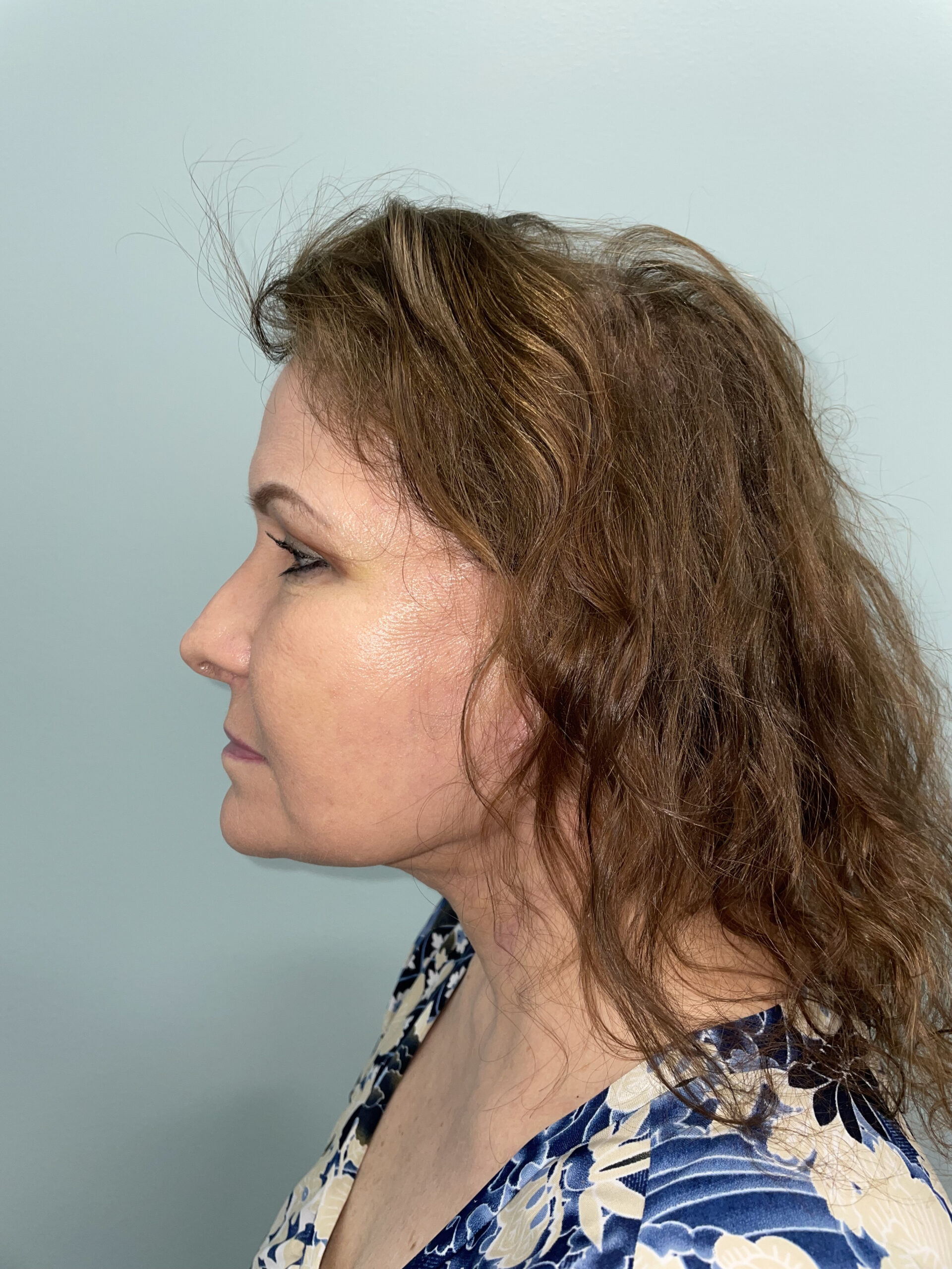 Blepharoplasty Patient Photo - Case 3741 - after view