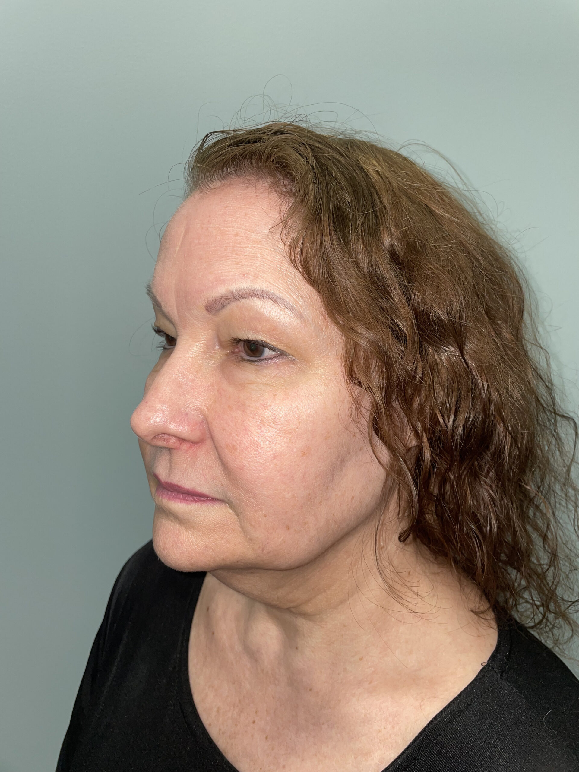 Blepharoplasty Patient Photo - Case 3741 - before view-