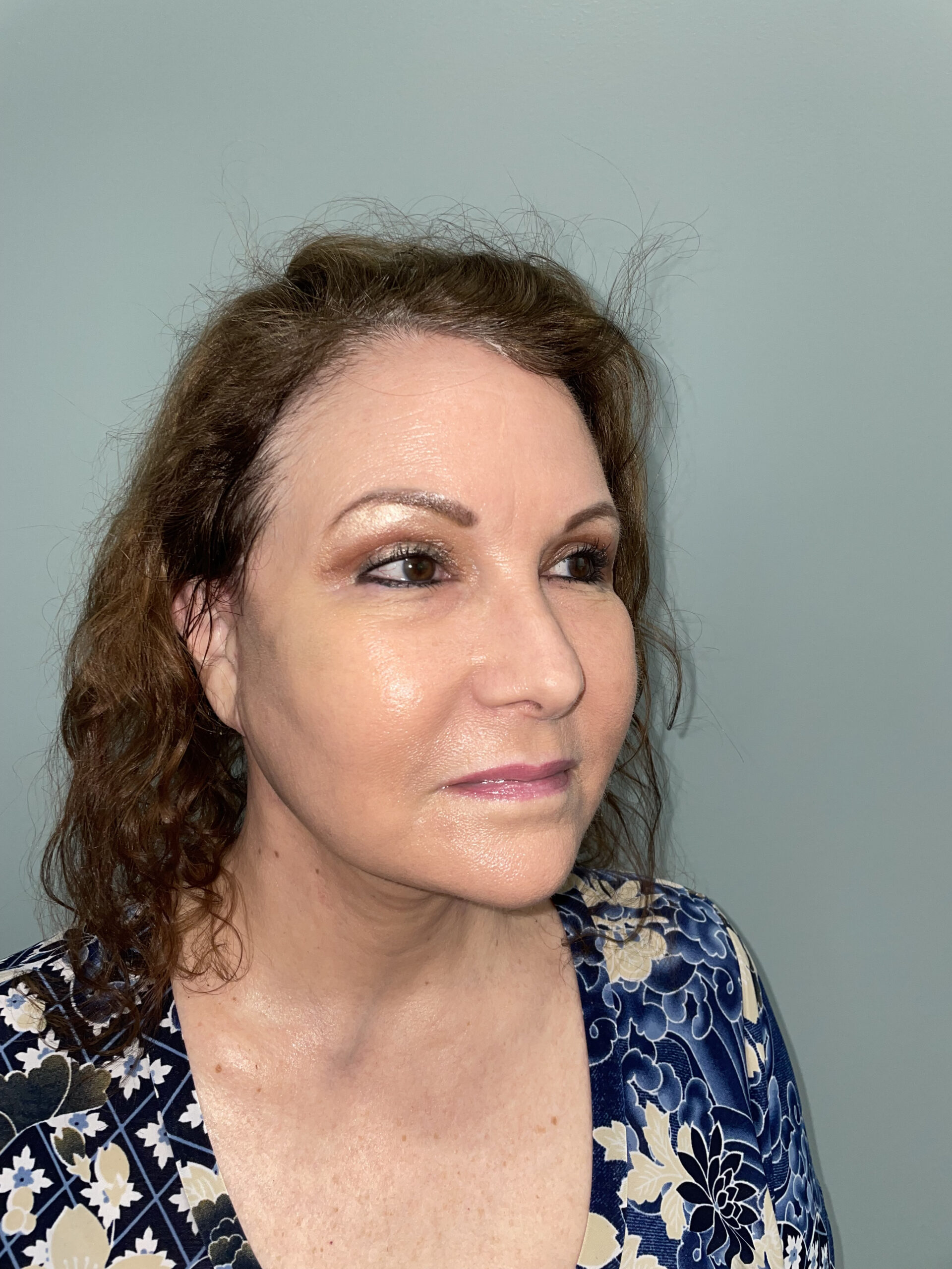 Blepharoplasty Patient Photo - Case 3741 - after view