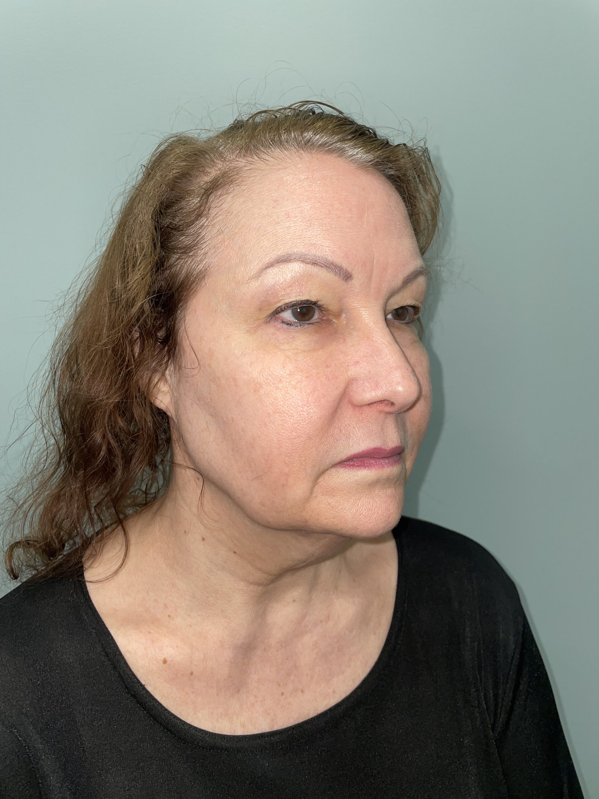 Blepharoplasty Patient Photo - Case 3741 - before view-