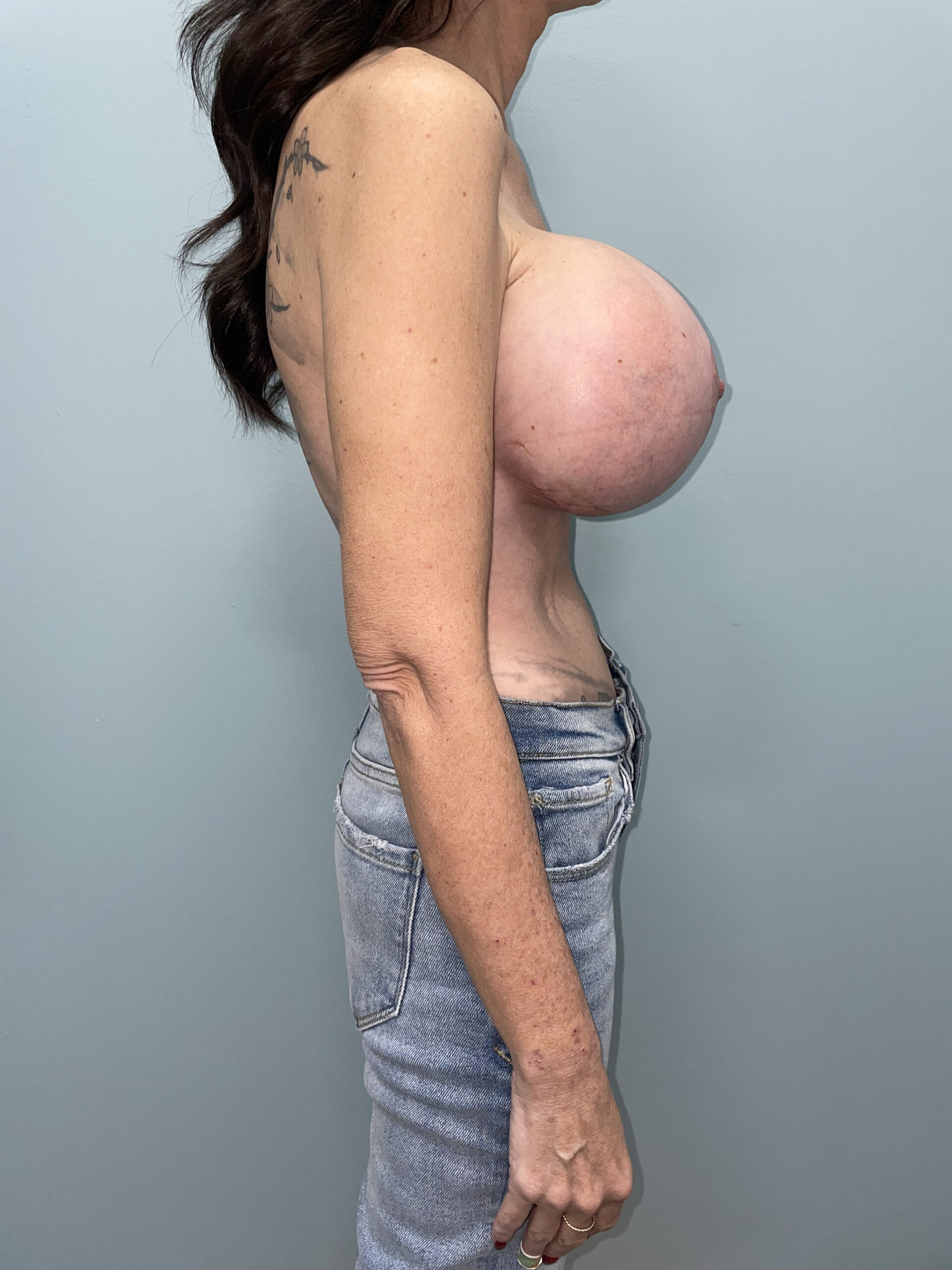 Breast Augmentation Patient Photo - Case 3752 - after view