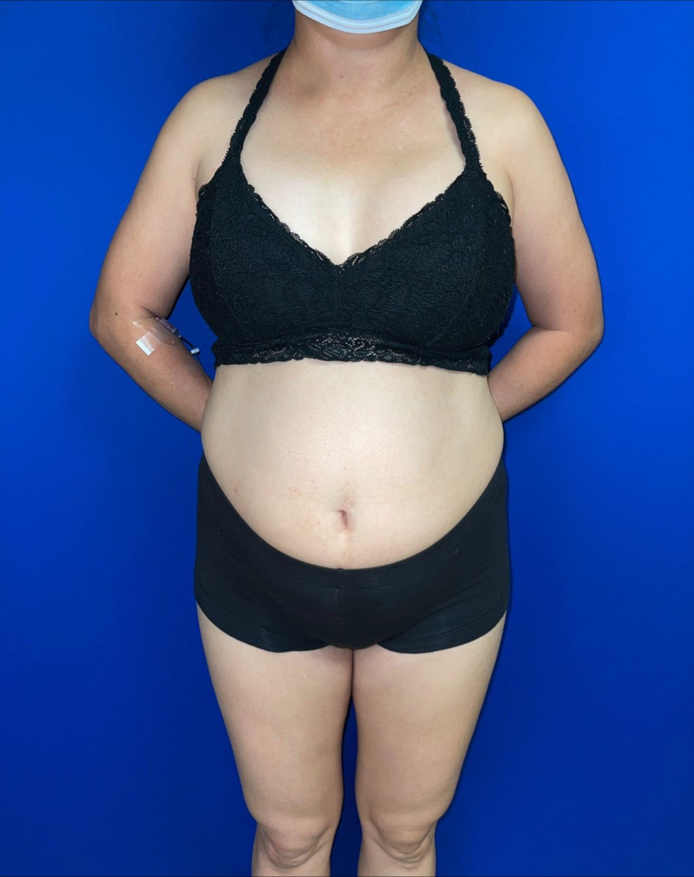 Tummy Tuck Patient Photo - Case 3759 - before view-0
