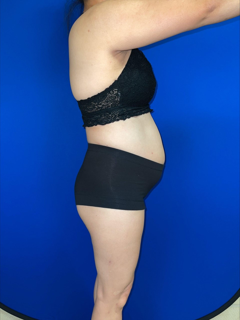 Tummy Tuck Patient Photo - Case 3759 - before view-4
