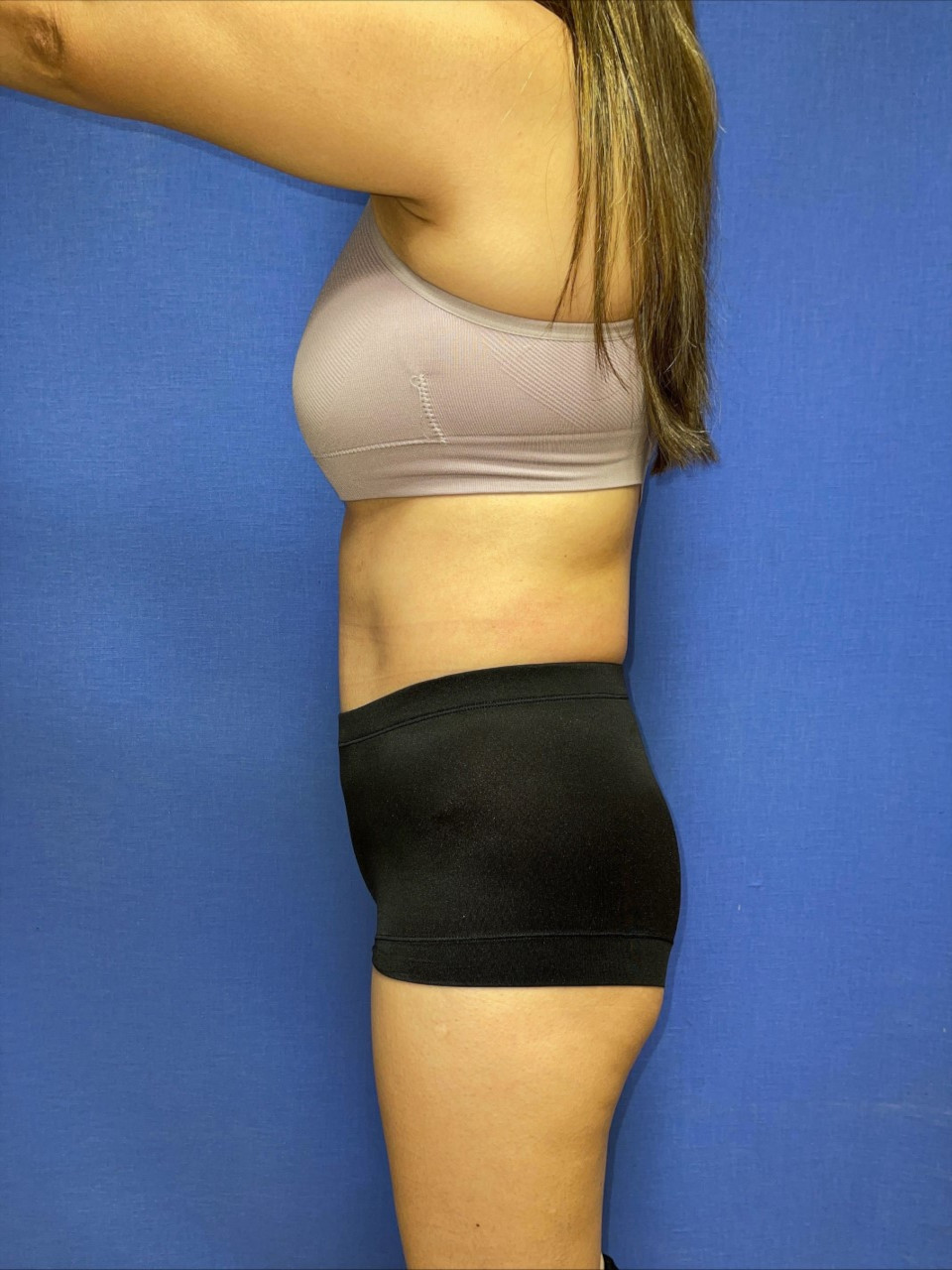 Tummy Tuck Patient Photo - Case 3759 - after view