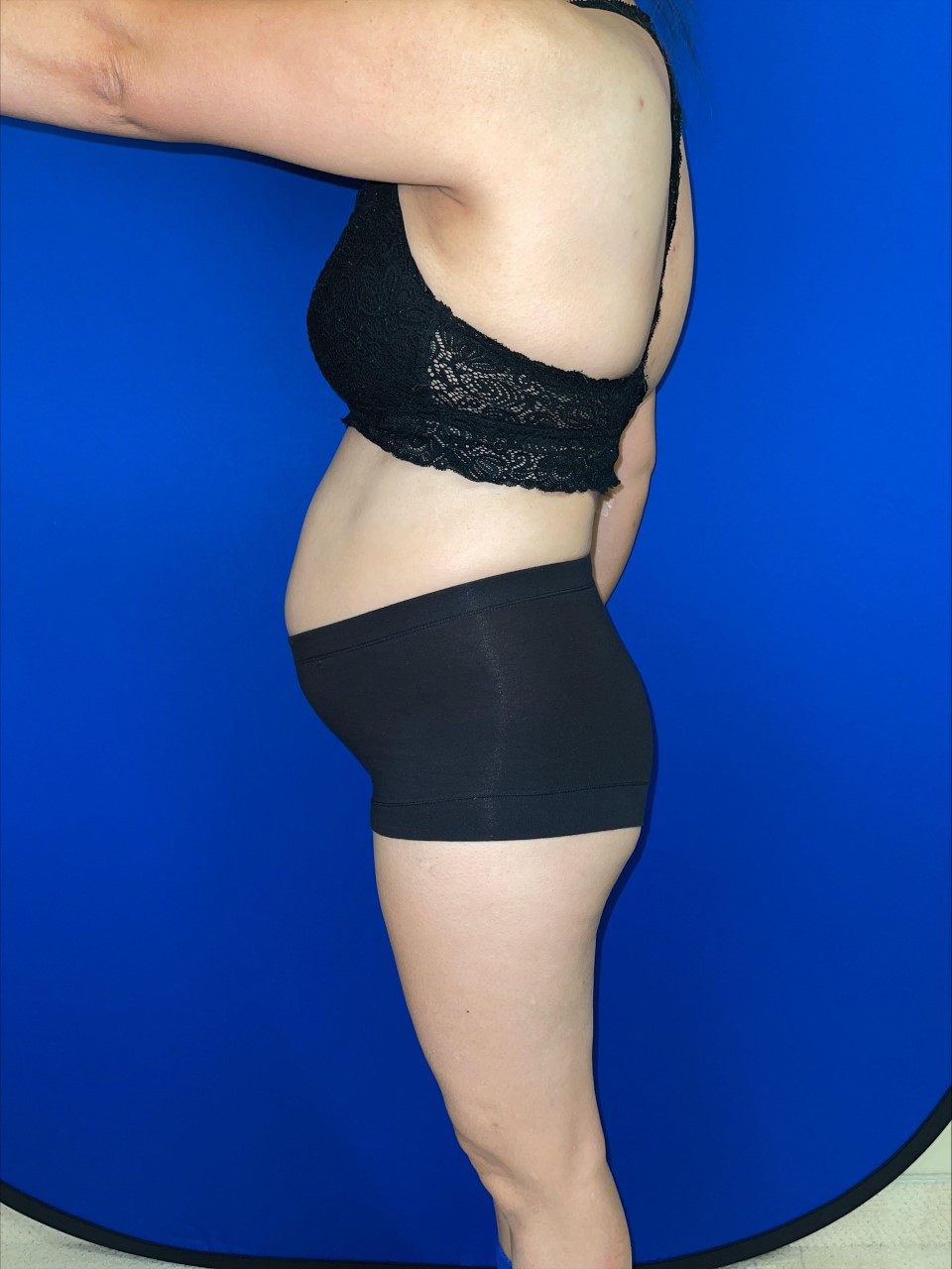 Tummy Tuck Patient Photo - Case 3759 - before view-2