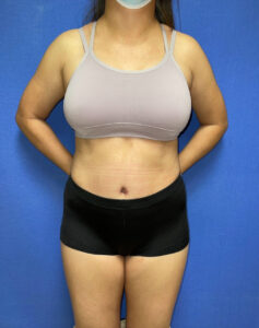 Tummy Tuck - Case 3759 - After