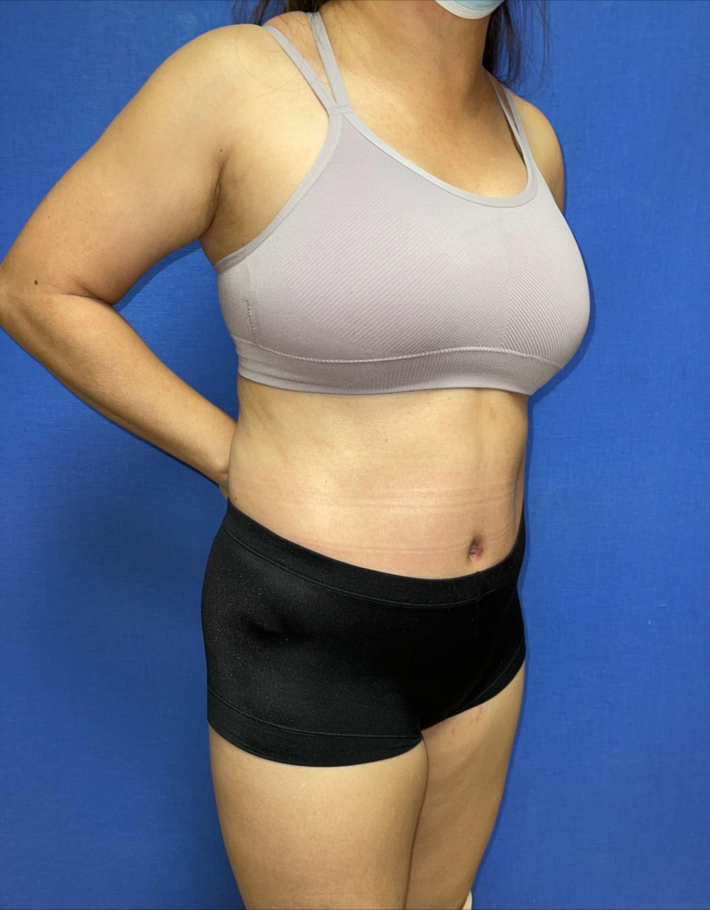 Tummy Tuck Patient Photo - Case 3759 - after view
