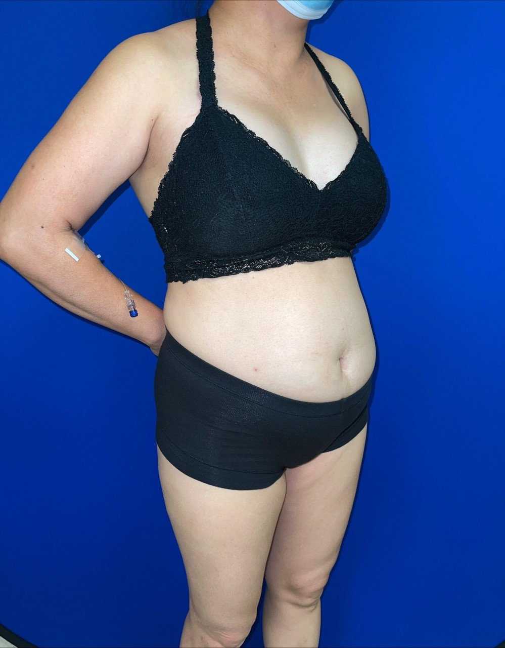 Tummy Tuck Patient Photo - Case 3759 - before view-1