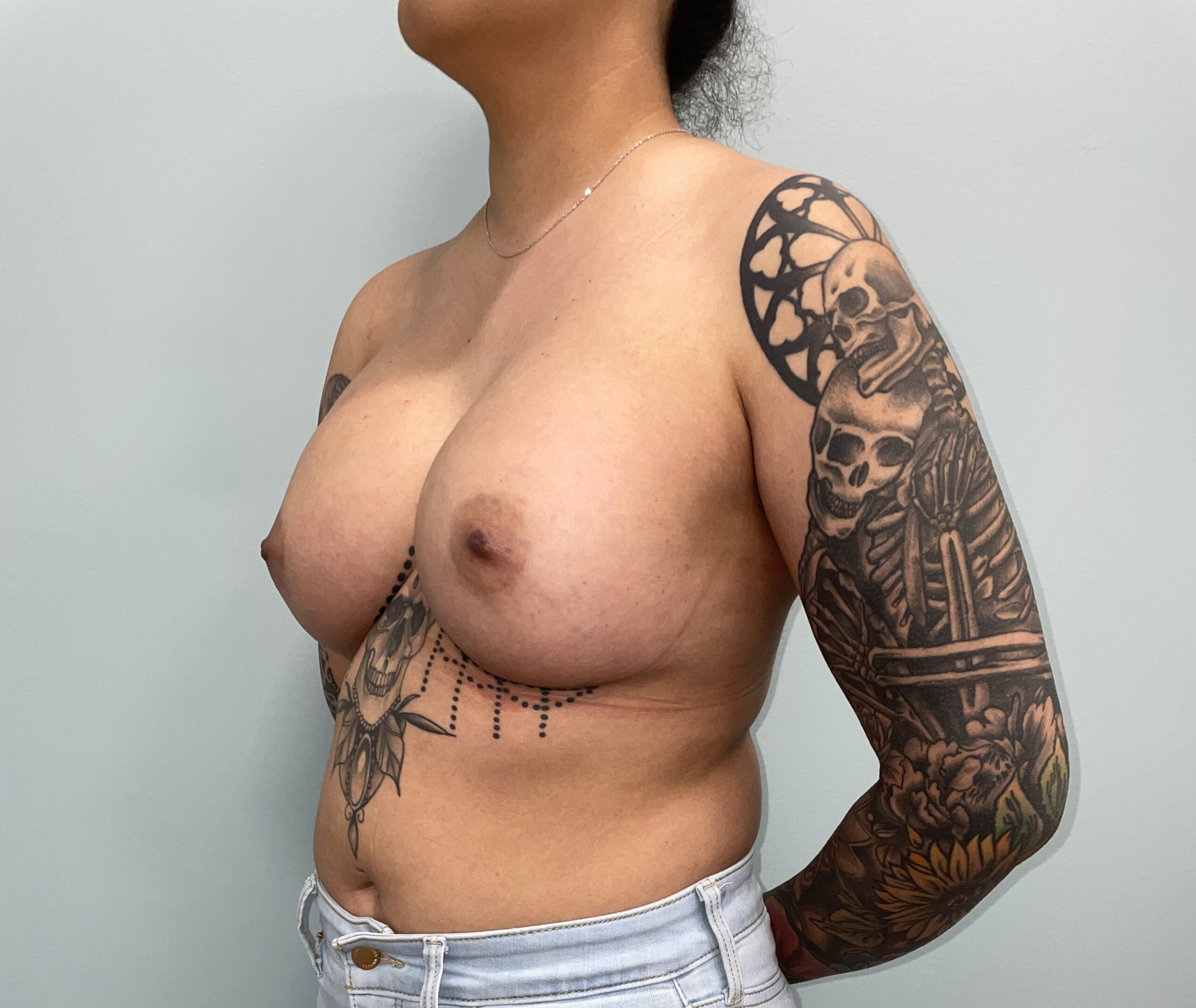 Breast Augmentation Patient Photo - Case 3770 - after view-1