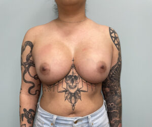 Breast Augmentation - Case 3770 - After