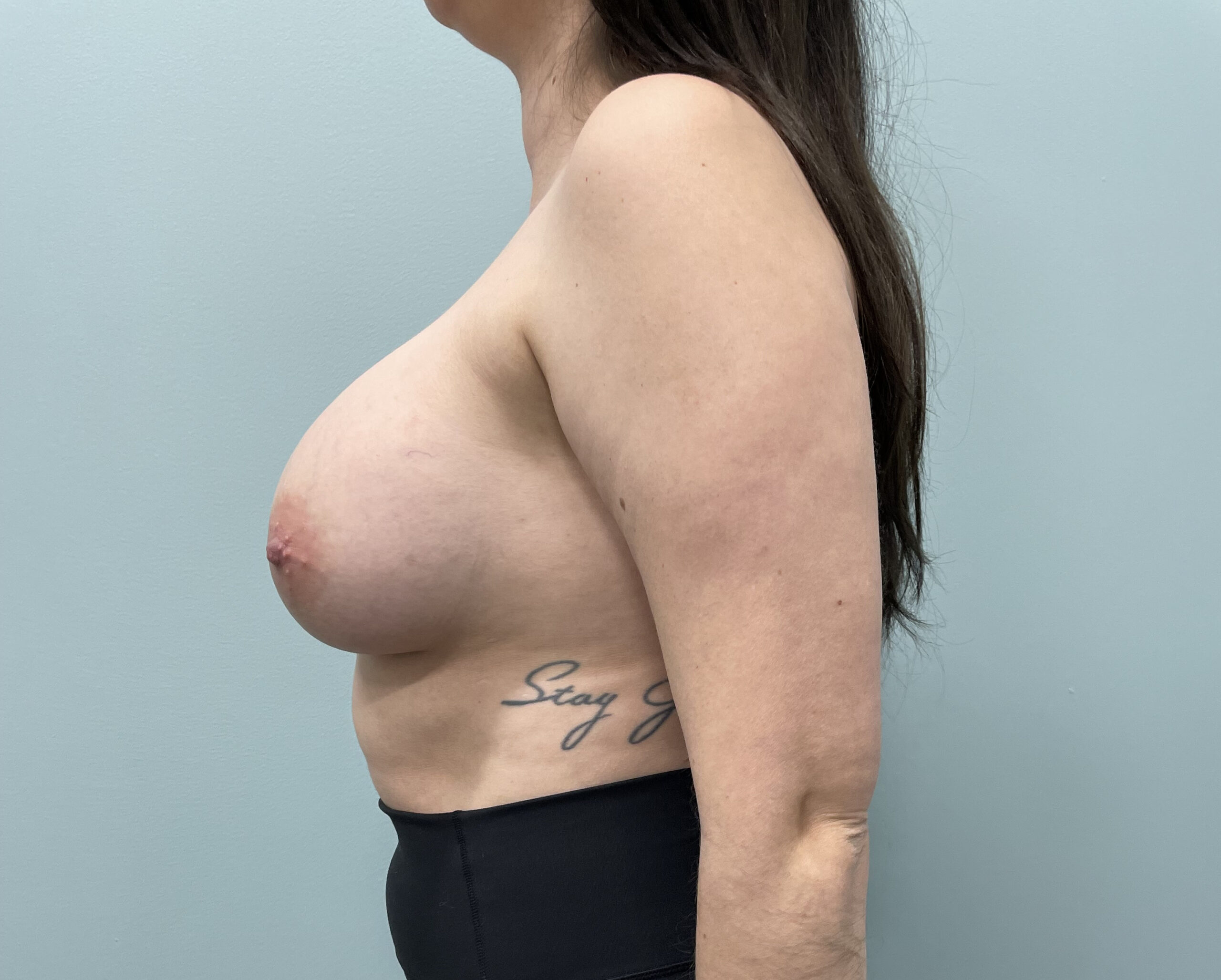 Breast Augmentation Patient Photo - Case 3781 - after view