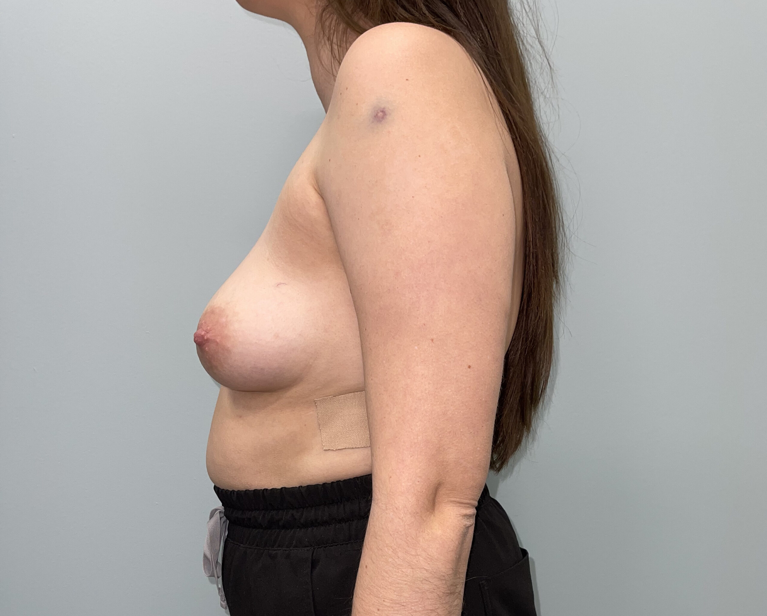 Breast Augmentation Patient Photo - Case 3781 - before view-