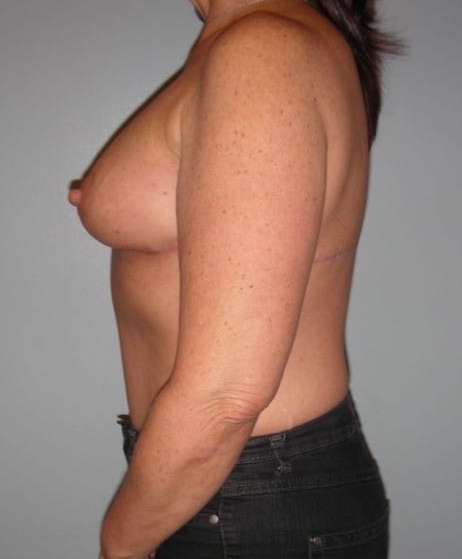 Breast Lift Patient Photo - Case 3792 - after view-2