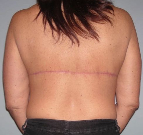 Breast Lift Patient Photo - Case 3792 - after view-3