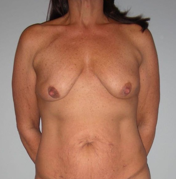 Breast Lift Patient Photo - Case 3792 - before view-0