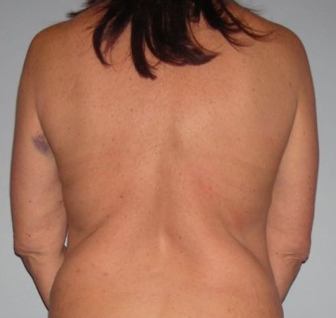 Breast Lift Patient Photo - Case 3792 - before view-3