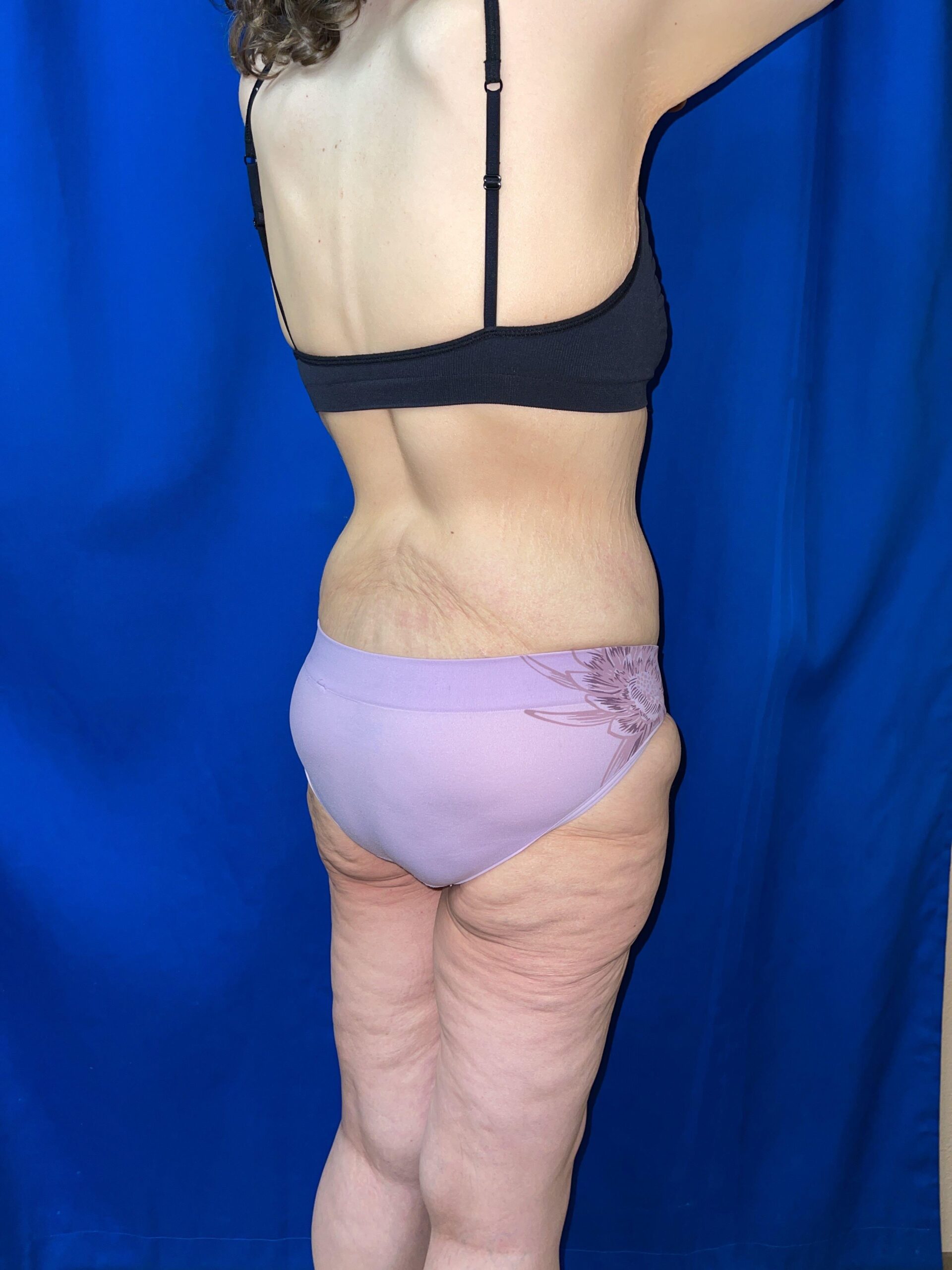 Body Lift Patient Photo - Case 3831 - before view-