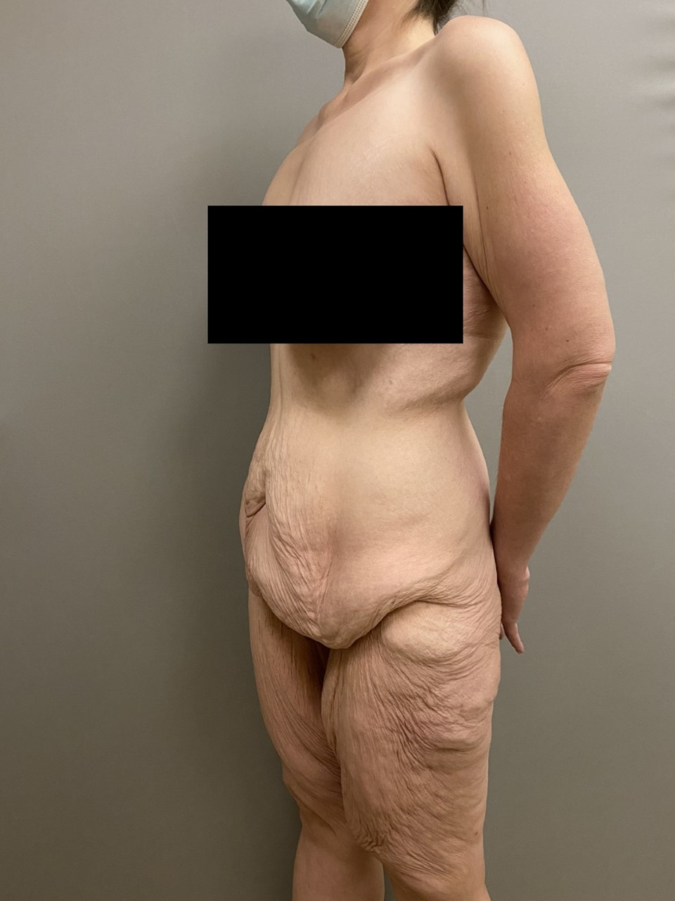 Body Lift Patient Photo - Case 3866 - before view-