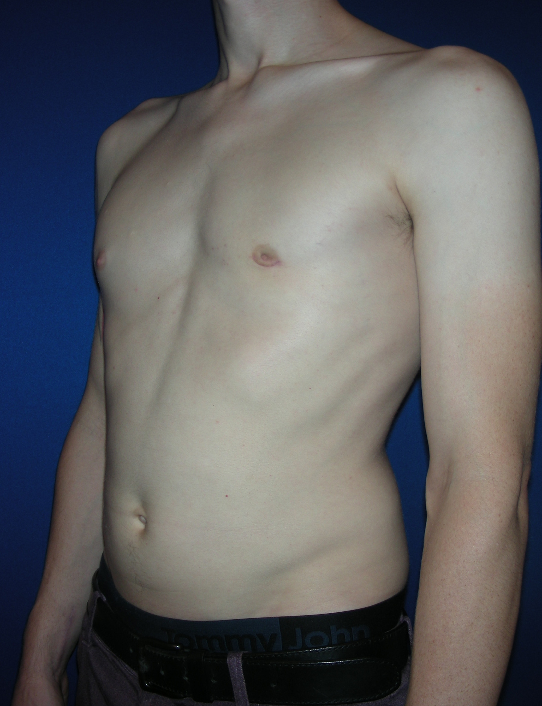 Male Breast Reduction Patient Photo - Case 3887 - after view
