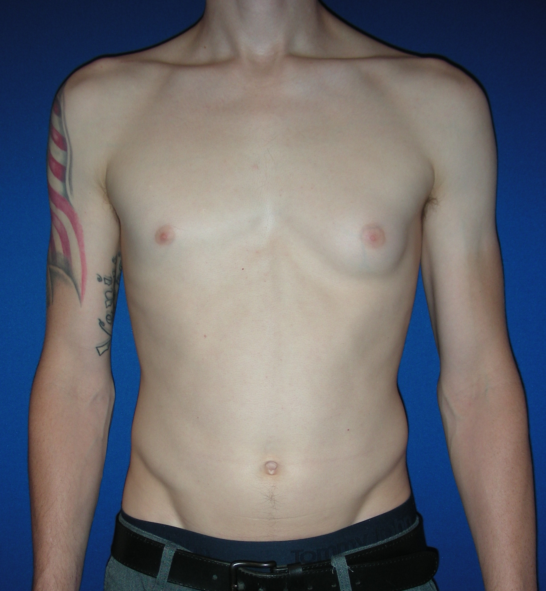 Male Breast Reduction Patient Photo - Case 3887 - before view-0