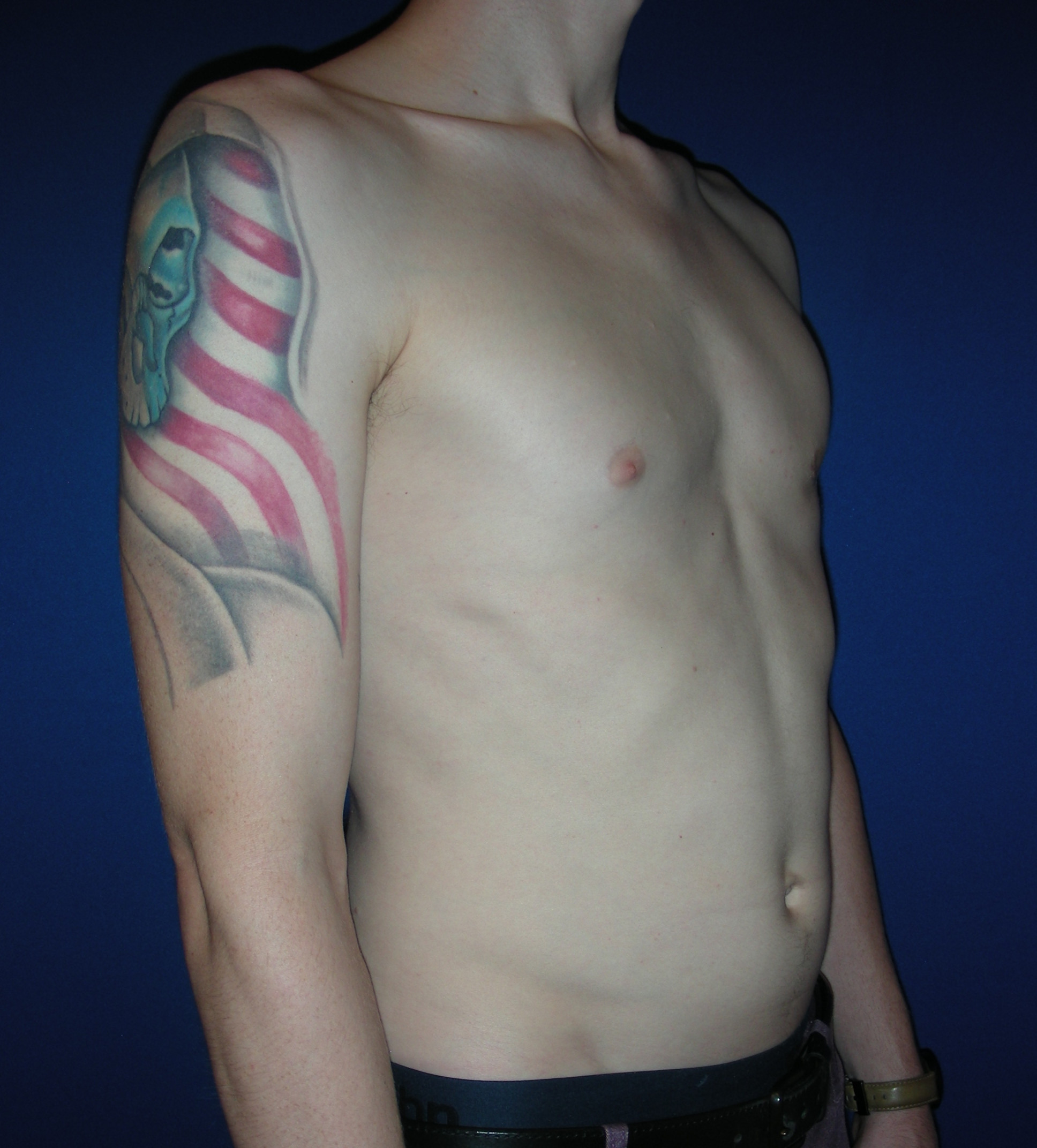 Male Breast Reduction Patient Photo - Case 3887 - after view-1