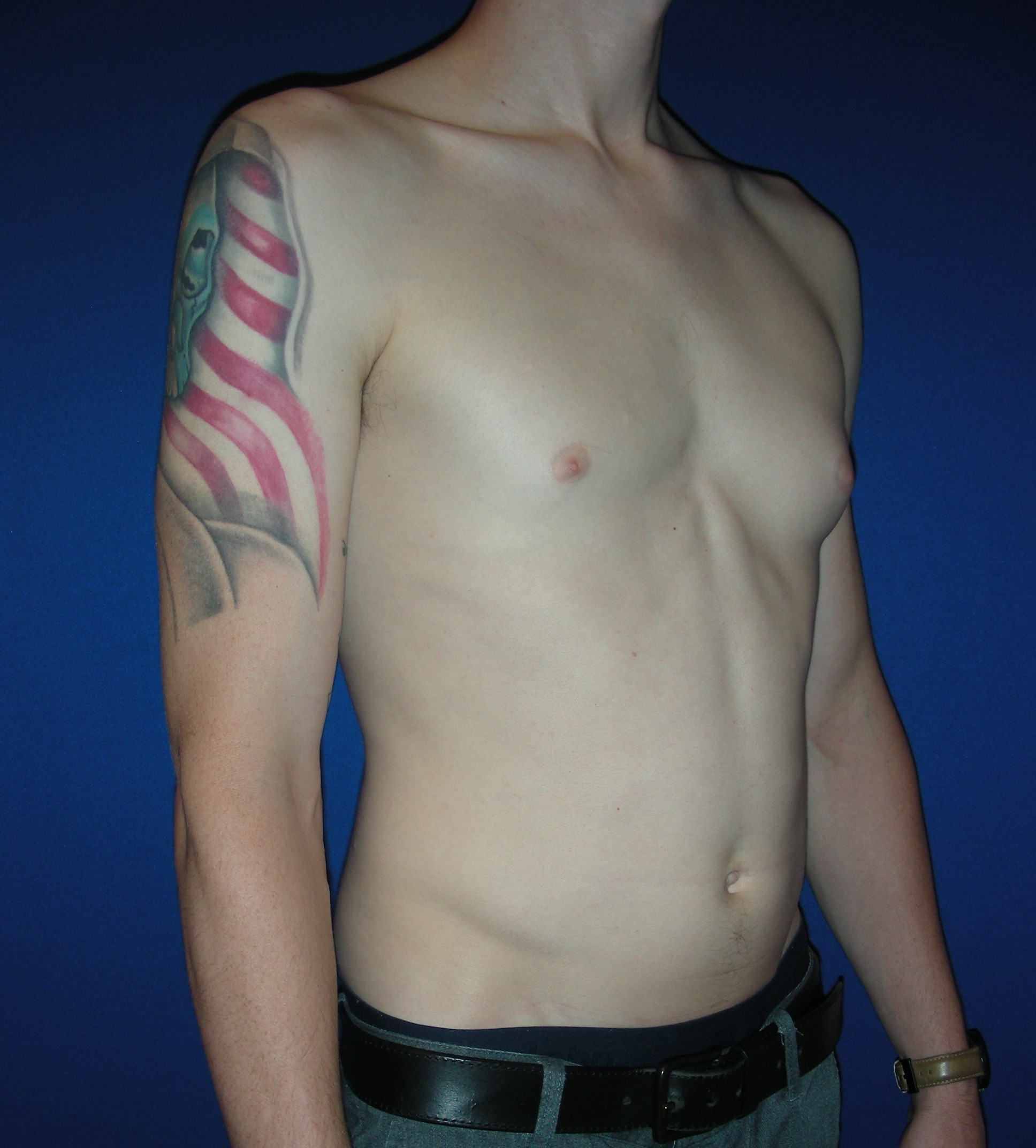 Male Breast Reduction Patient Photo - Case 3887 - before view-1