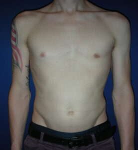 Male Breast Reduction - Case 3887 - After