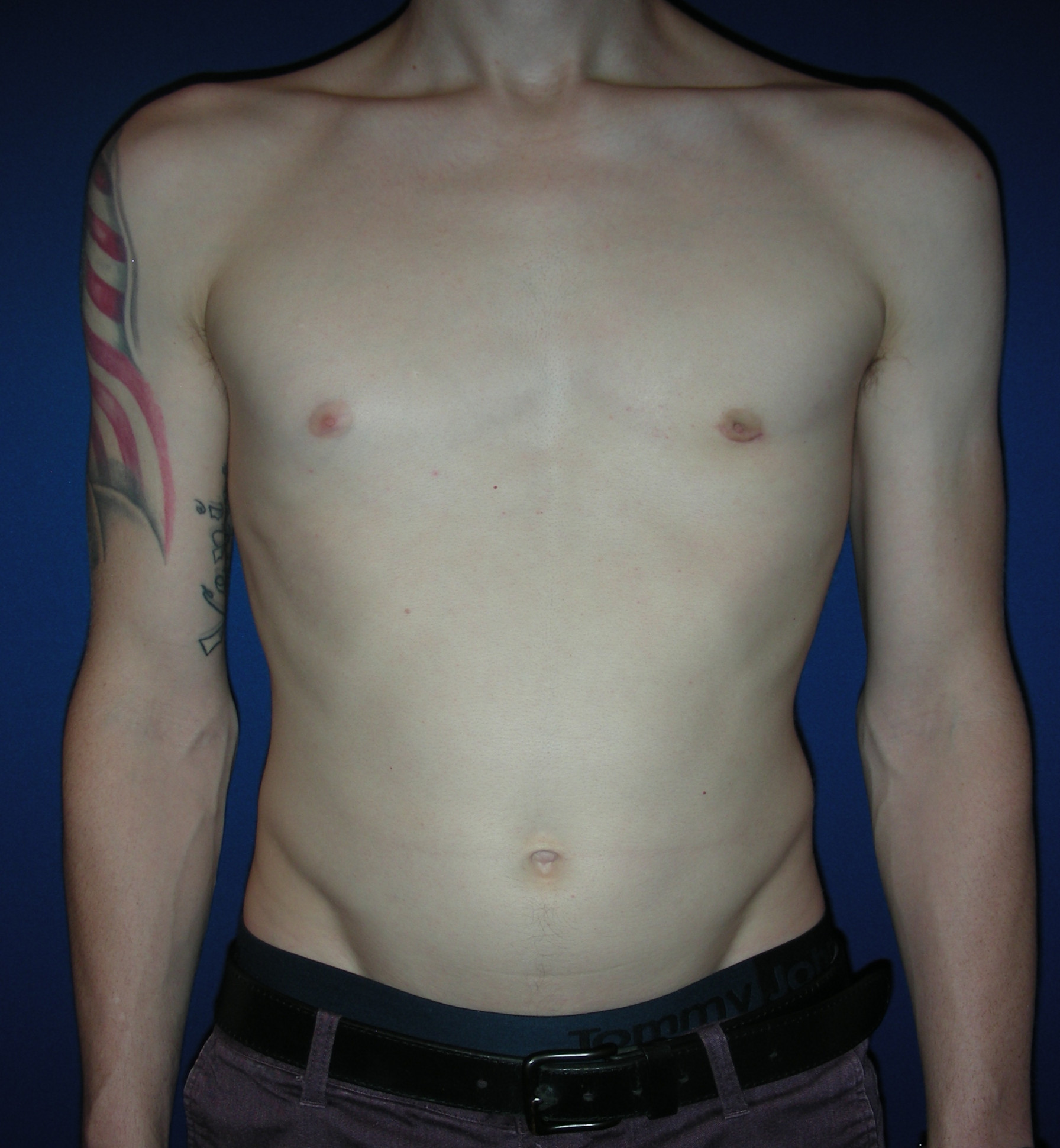 Male Breast Reduction Patient Photo - Case 3887 - after view-0