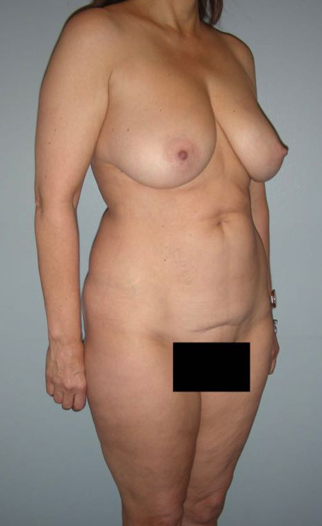 Mommy Makeover Patient Photo - Case 3898 - before view-
