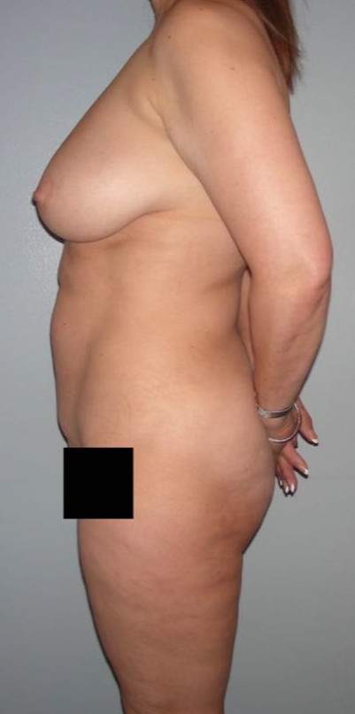Mommy Makeover Patient Photo - Case 3898 - before view-