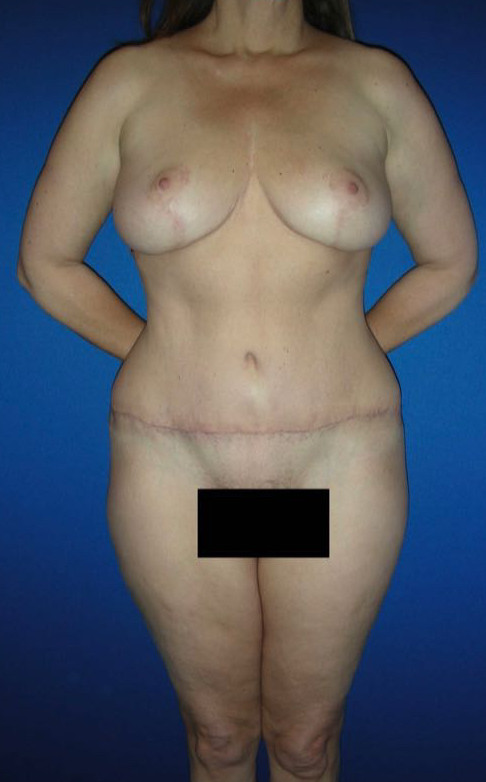Mommy Makeover Patient Photo - Case 3898 - after view