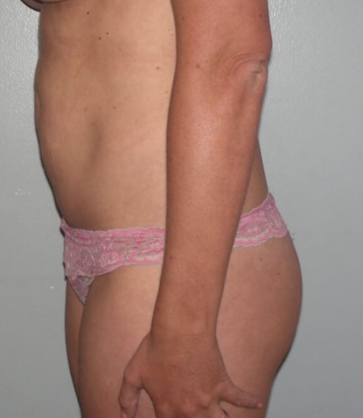 Tummy Tuck Patient Photo - Case 3920 - before view-2