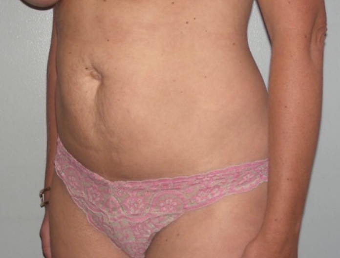Tummy Tuck Patient Photo - Case 3920 - before view-1