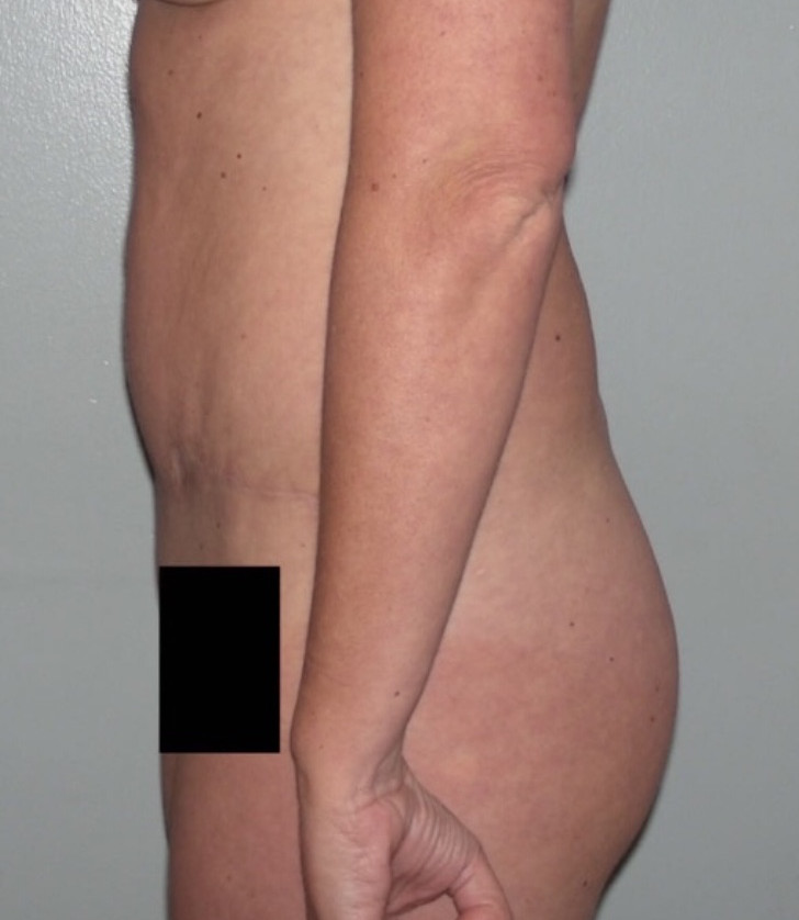 Tummy Tuck Patient Photo - Case 3920 - after view-2