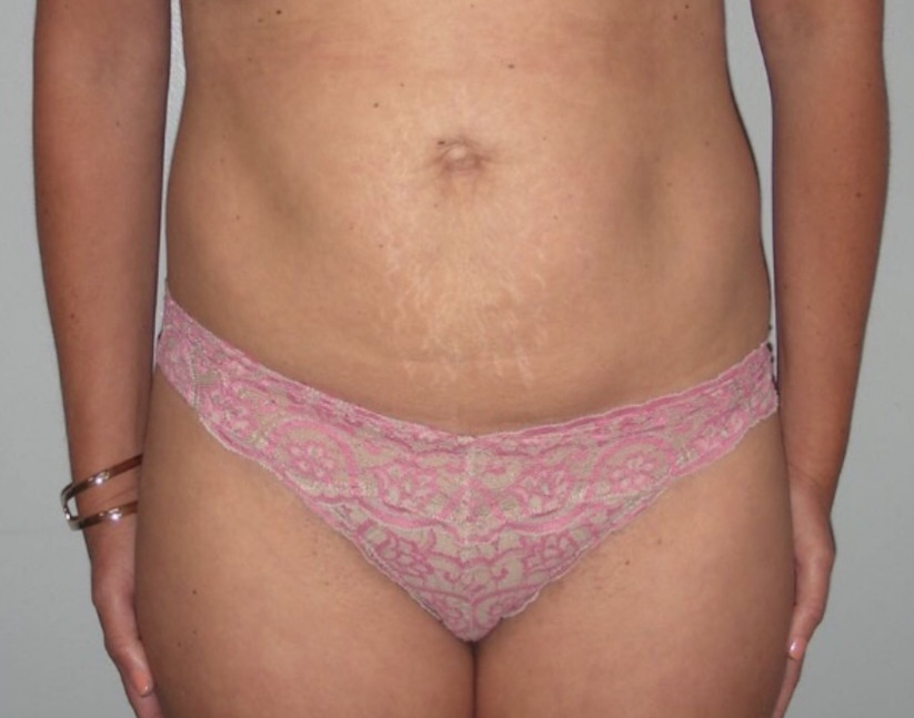 Tummy Tuck Patient Photo - Case 3920 - before view-0