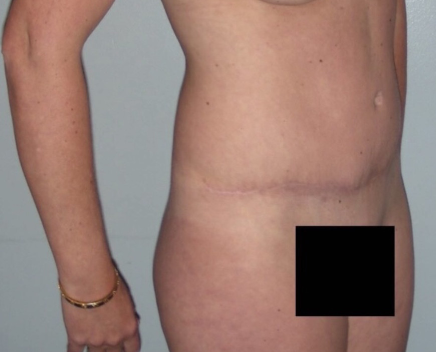 Tummy Tuck Patient Photo - Case 3920 - after view-3