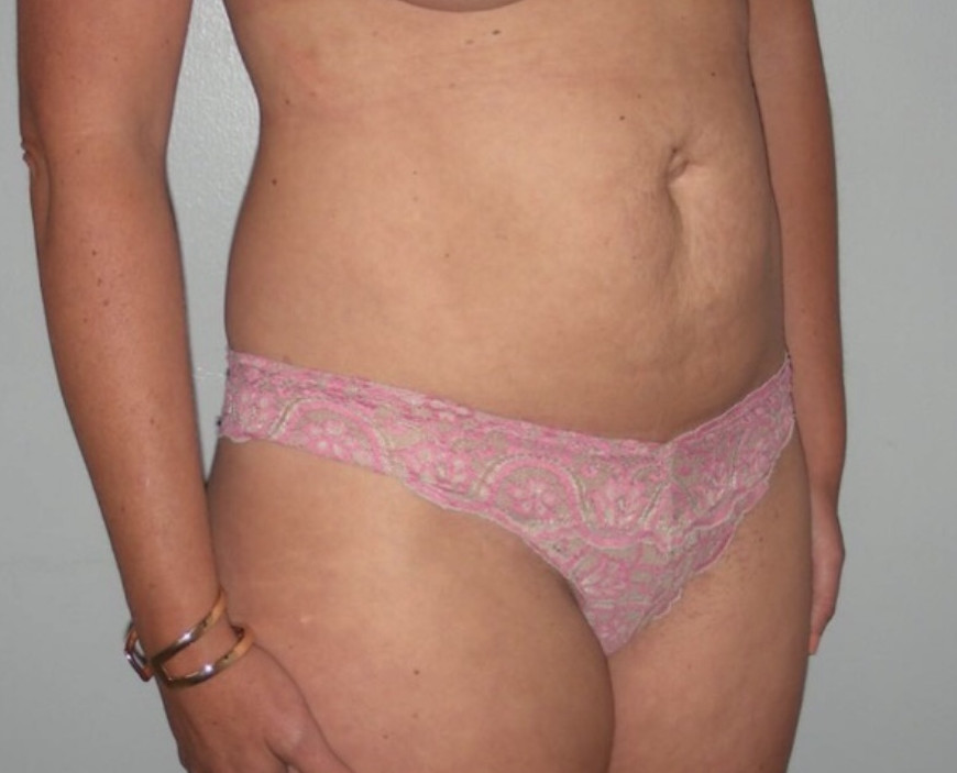 Tummy Tuck Patient Photo - Case 3920 - before view-3