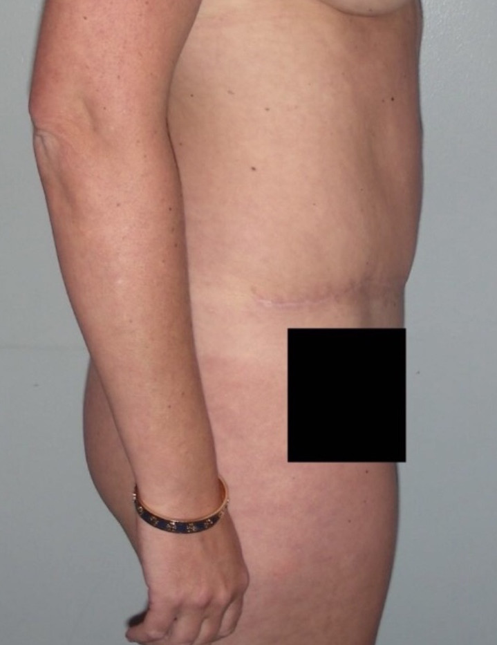 Tummy Tuck Patient Photo - Case 3920 - after view-4