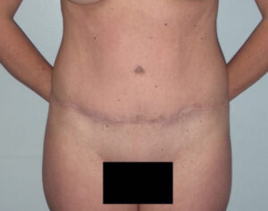Tummy Tuck - Case 3920 - After
