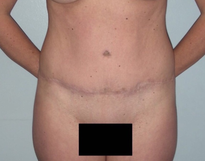 Tummy Tuck Patient Photo - Case 3920 - after view-0