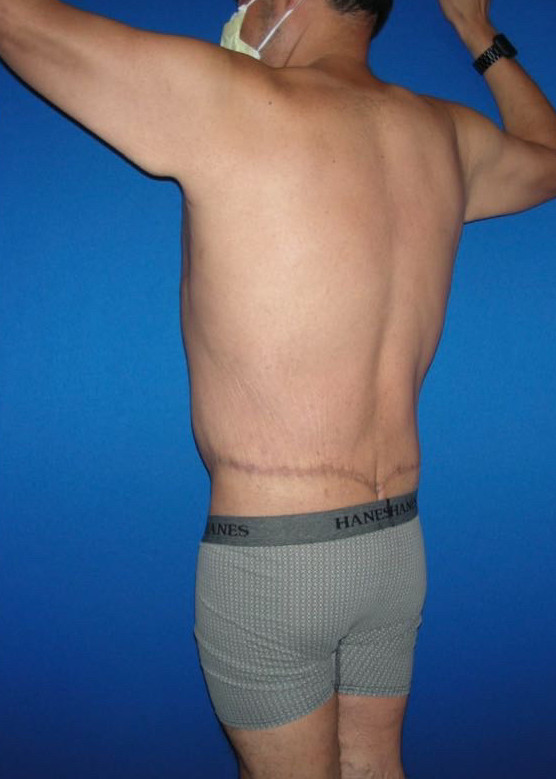 Tummy Tuck Patient Photo - Case 3931 - after view