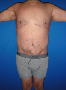 Tummy Tuck - Case 3931 - After