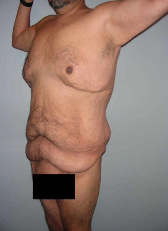 Tummy Tuck Patient Photo - Case 3931 - before view-