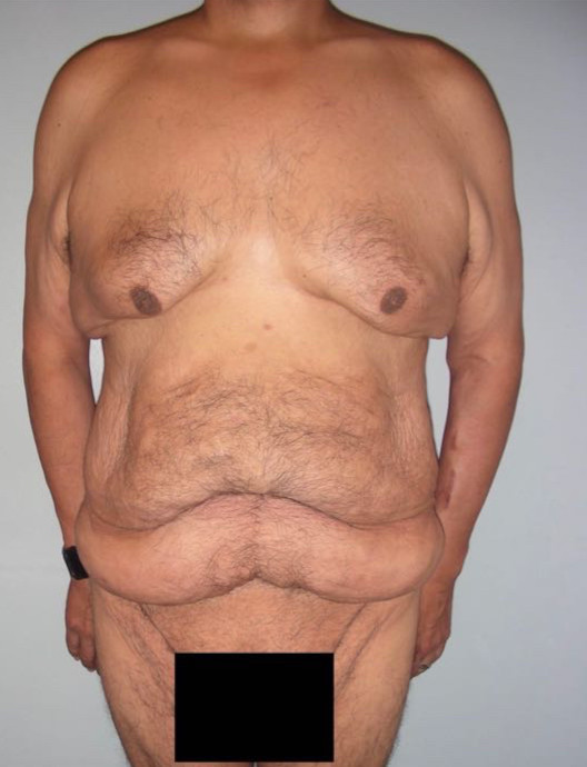 Tummy Tuck Patient Photo - Case 3931 - before view-
