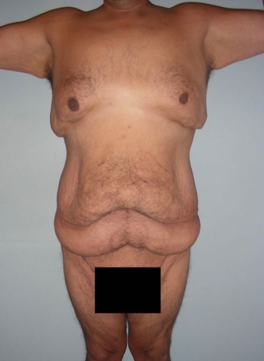 Tummy Tuck Patient Photo - Case 3931 - before view-0